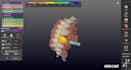 create accurate implant prosthesis designs using exocad