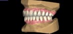 do highly ethetics dental restorations aox bridges on exocad