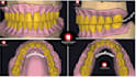 designe a professional full denture on exocad with high quality