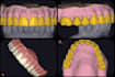 designe a partial denture , custom tray , baseplate on exocad with high quality
