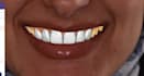 create esthetic veneer designs and dsd in exocad