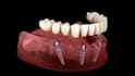 do 3d dental implant animation orthodontic brace and root canal explainer video