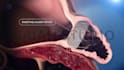 do 3d medical device animation catheter heart implant anatomy surgery explainer