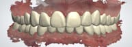 design highly precise perfect dental fixed prothesis using  3shape
