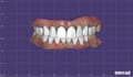 create accurate crowns and bridges using exocad