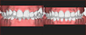 create clear aligner treatment planning services