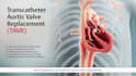 create 3d medical animation cardiovascular tavr heart aortic valve visualization