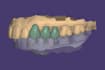 design crown and bridges in exocad