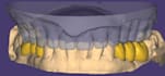 design dental crown and bridge using exocad