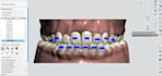 custom aligner treatment plans with 3d clincheck