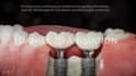 do 3d dental implant animation 3d abutmen crown explainer and surgery procedure