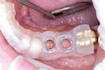 design custom dental implant surgical guide