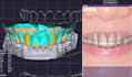 do exocad dental implant design fast and accurately