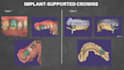 design dental cad crowns, bridges and implants using exocad