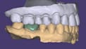 design your exocad crown accurately