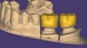 dental crown design exocad