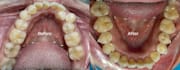 make clear aligner with 3shape