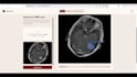 ai medical disease diagnosis, tumor detection and scan tools