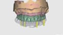 do expert dental designs on exocad