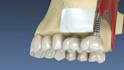 create realistic 3d dental implant animation and dental surgery animation