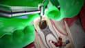 create 3d medical animation tooth anatomy gum disease dental implant procedure