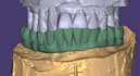 design crowns, bridges, implants, full arch cases using exocad