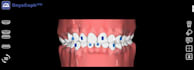 design clear aligner treatment plans