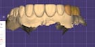 design professional dental cad crwonbridge using exocad