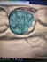 create high quality dental cad desings using exocad