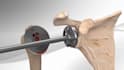 create medical device 3d surgery process explainer animation surgical simulation