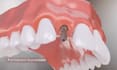 do 3d dental implant animation, patient education, explainer video