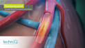 do 3d medical device animation 3d surgery animation 3d medical explainer video