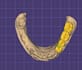 design professional dental cad cases using exocad
