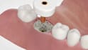 3d dental animation dental implant socket procedure bone graft explainer video