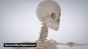 do 3d medical animation cervical disc replacement spine surgery anatomy video