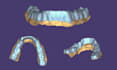 design occlusal splints, night guards and retainers