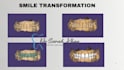 design 3d printed veneer smile makeovers using exocad