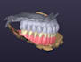 design functional and esthetic removable denture