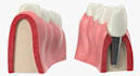 do 3d medical explainer 3d dental implant animation 3d dental surgical procedure