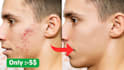 professional acne pimple blemish removal