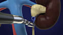create 3d medical animation surgical procedure urology surgery video