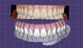 design dental cad restorations using exocad and 3shape