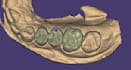professional exocad dental cad design