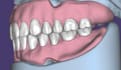 design precise full dentures using exocad