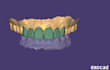 design professional exocad dental cad restorations