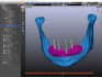 do implant planning ,surgical guide using blue sky and b4d