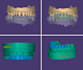 design precise exocad dental crowns, bridges and veneers
