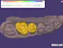 design crown and bridges using exocad