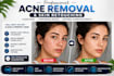 remove pimples, acne, scars and skin blemishes
