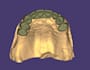design crowns, bridges, implants, dentures using exocad